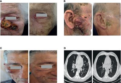 Cemiplimab in an Elderly Frail Population of Patients With Locally Advanced or Metastatic Cutaneous Squamous Cell Carcinoma: A Single-Center Real-Life Experience From Italy